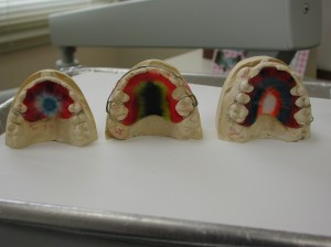 Examples of top retainer in mouth