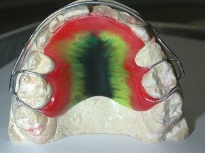 Examples of top retainer in mouth