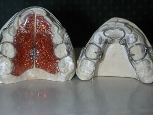 Examples of top and bottom retainer in mouth