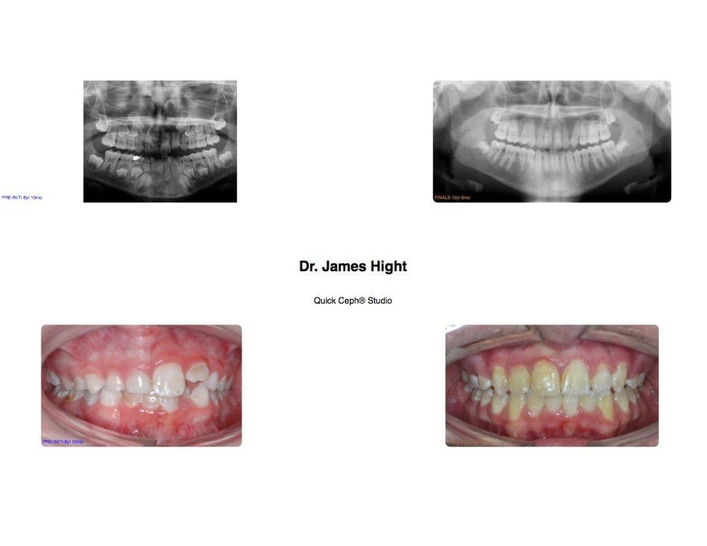 Comparison11-impaction