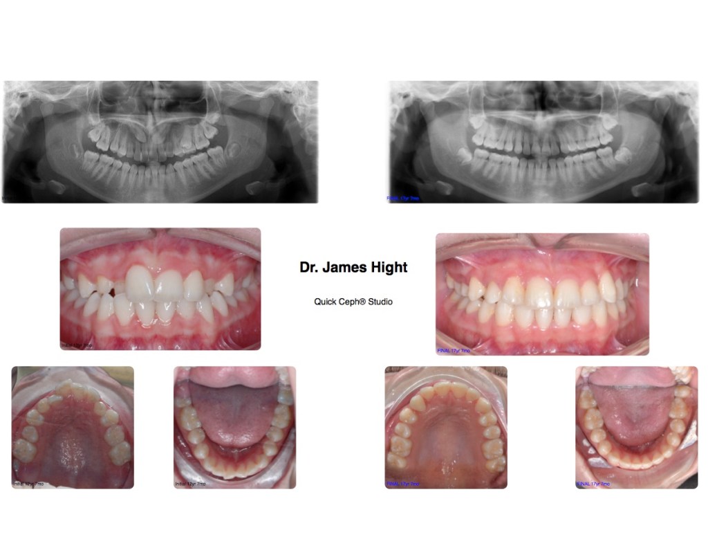 Comparison20-impaction
