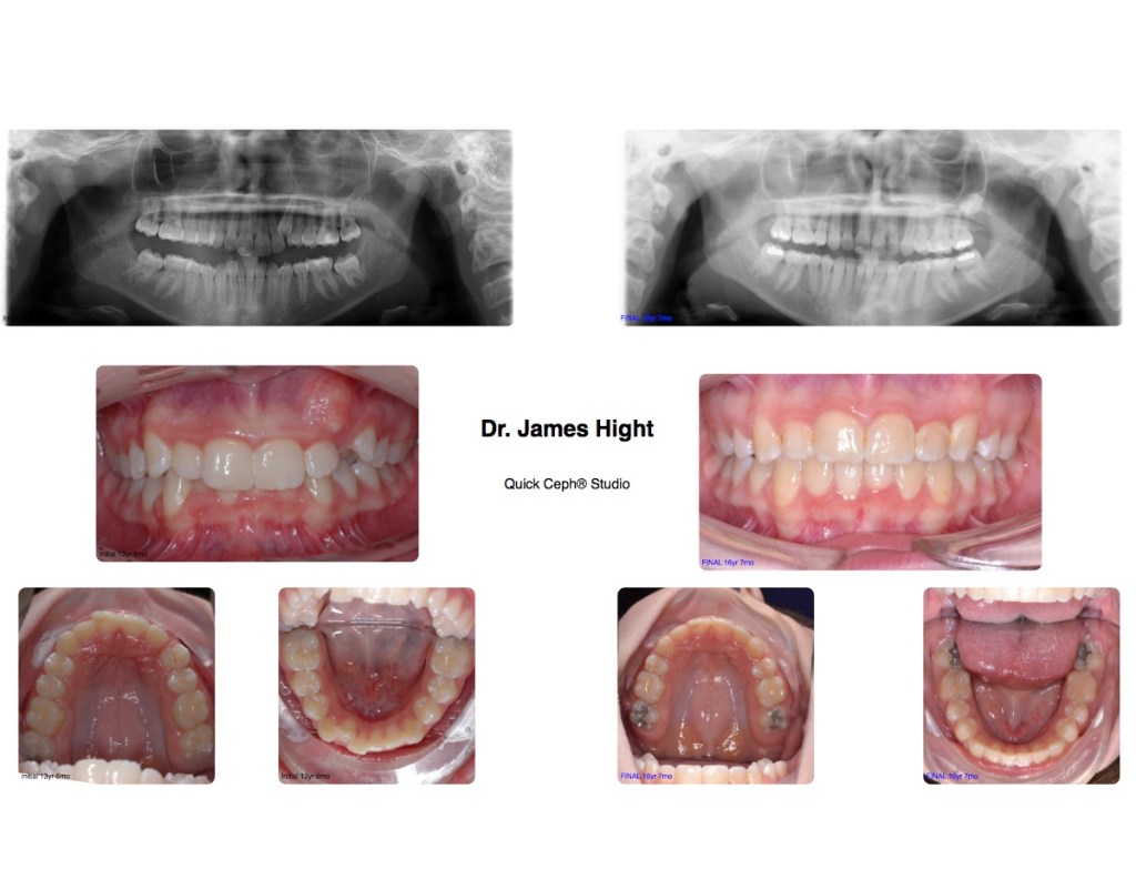 Comparison21-impaction