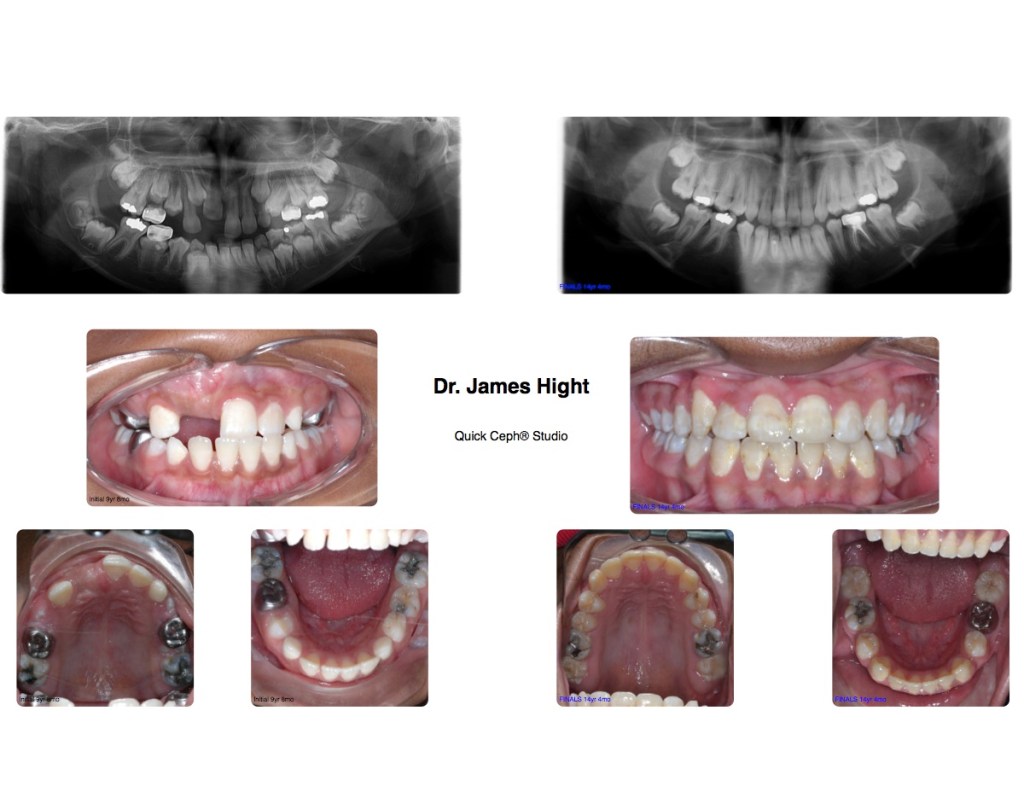 Comparison23-impaction