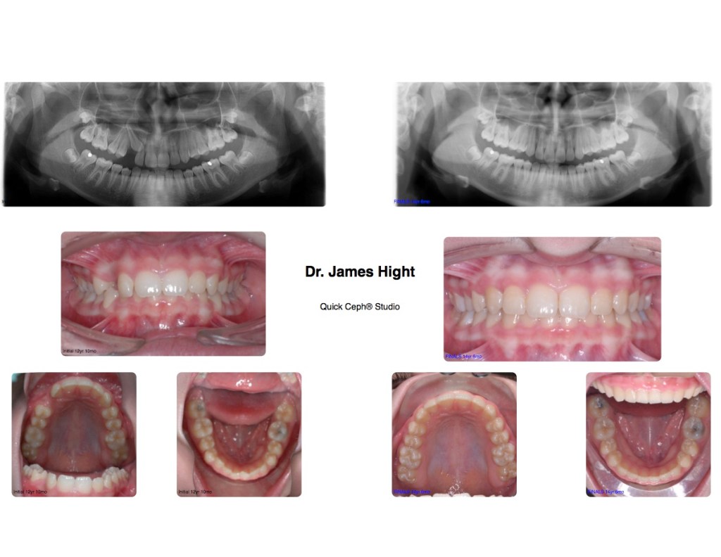 Comparison24-impaction