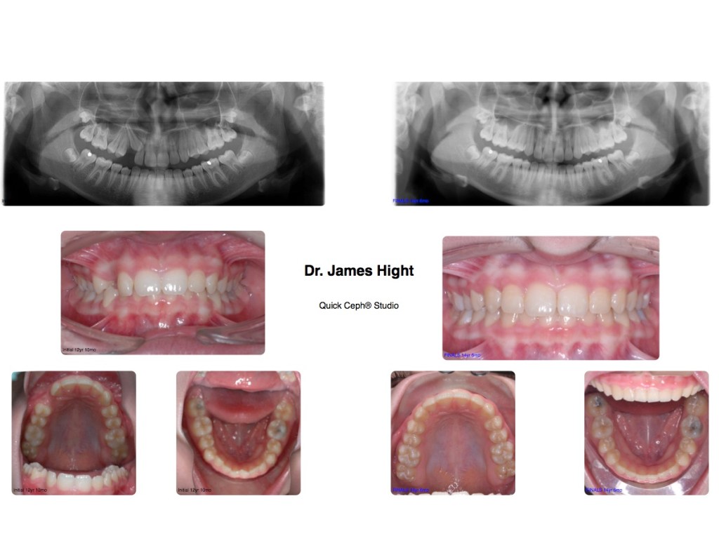 Comparison24-impaction