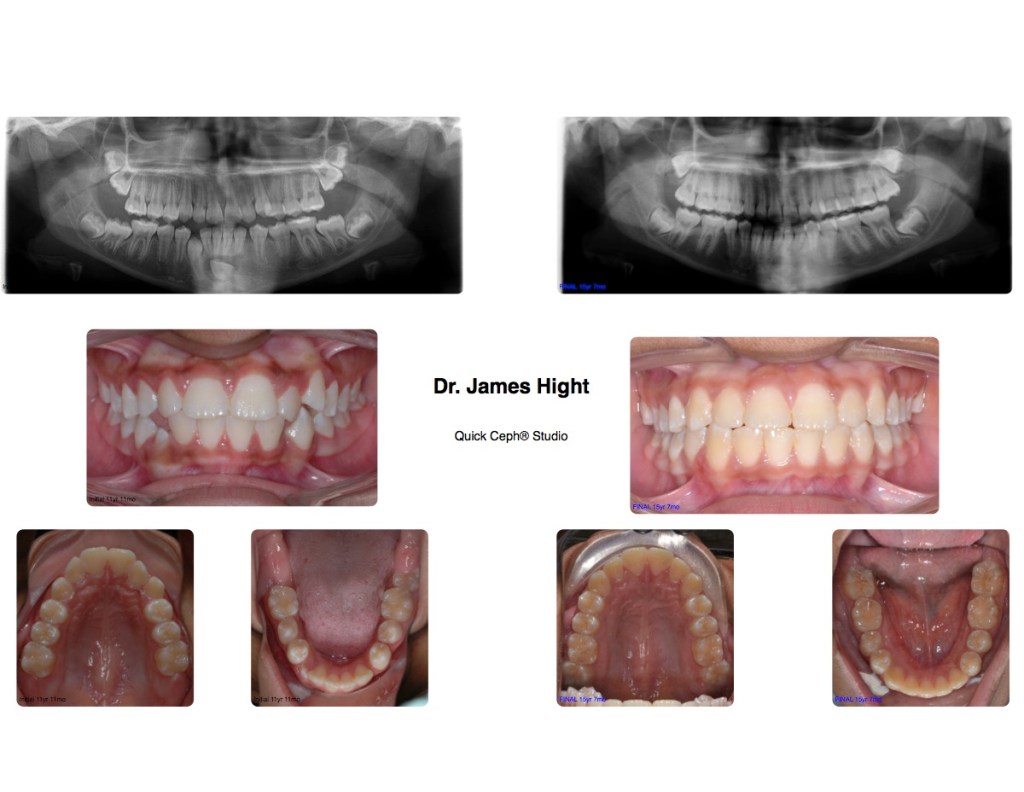 Comparison29-impaction