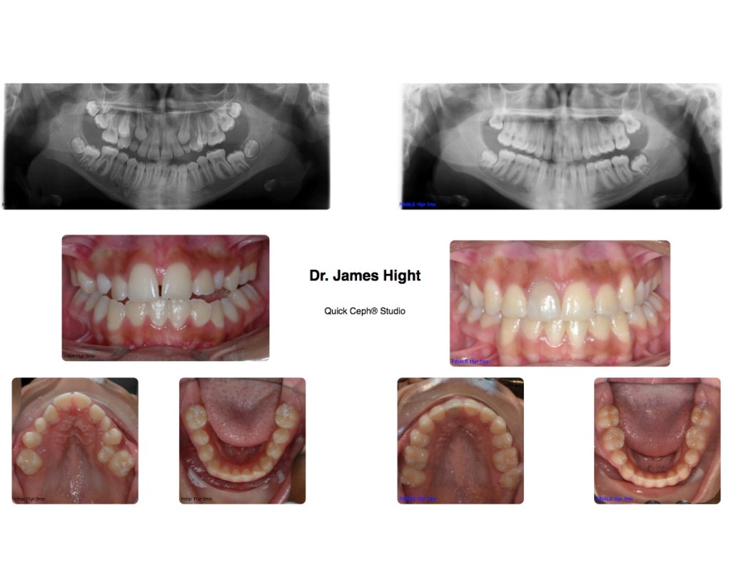 Comparison30-impaction