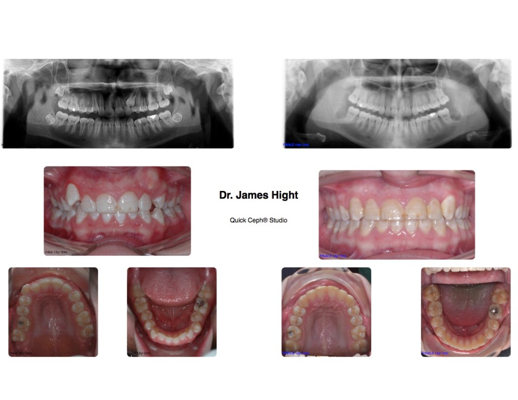 Comparison31-impaction