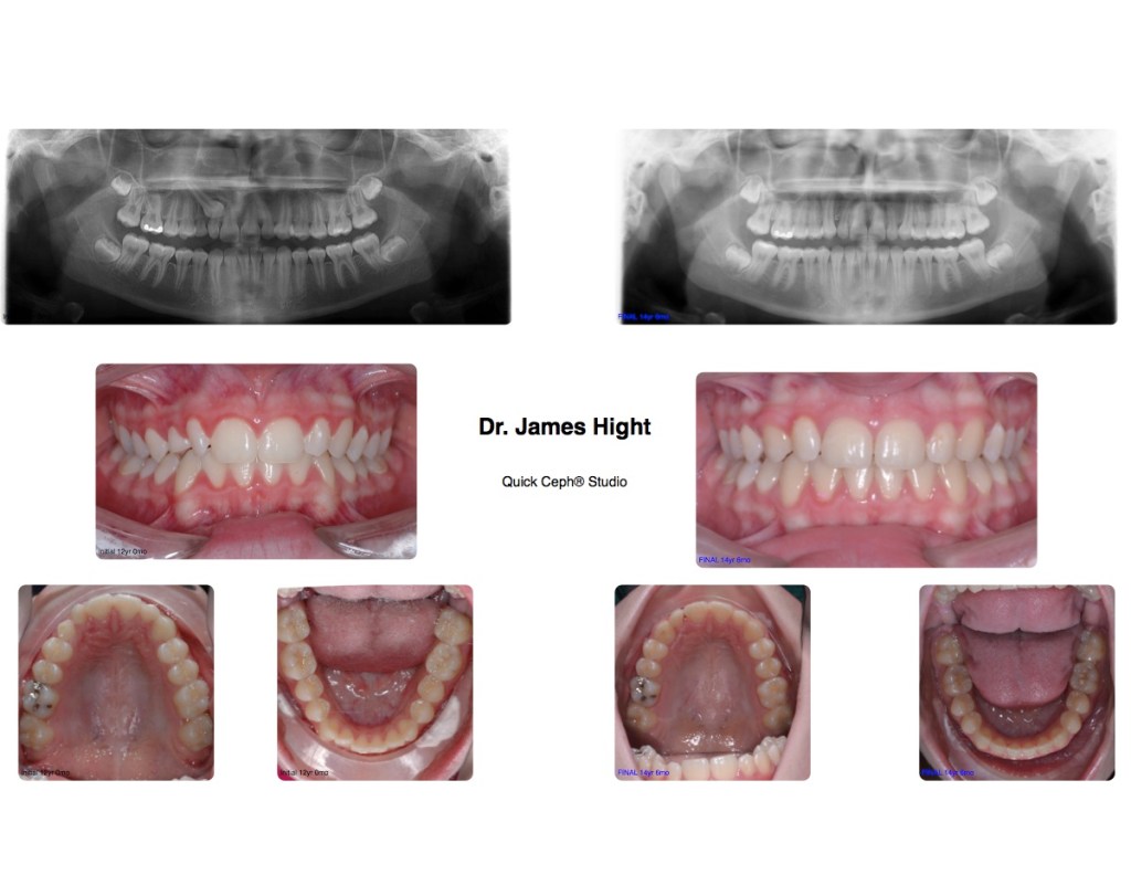 Comparison32-impaction