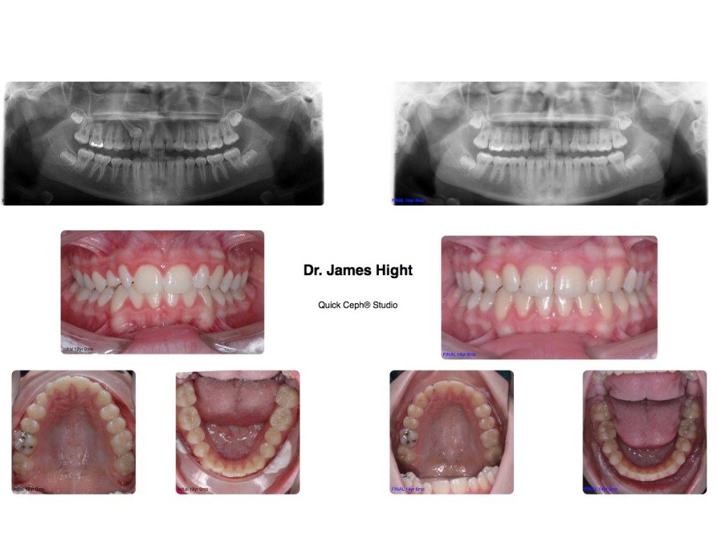 Comparison32-impaction