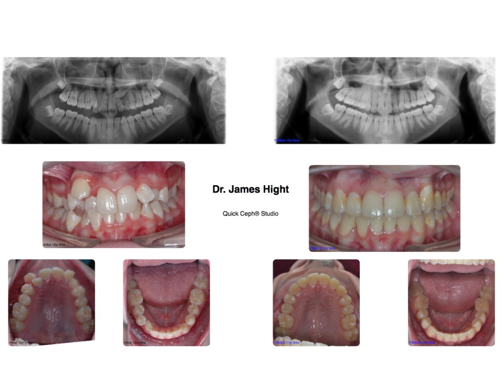 Comparison34-impaction