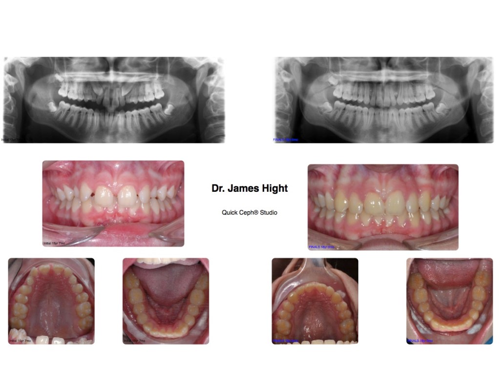 Comparison35-impaction