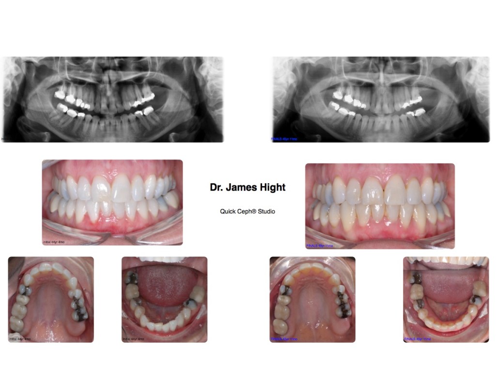 Comparison37-impaction
