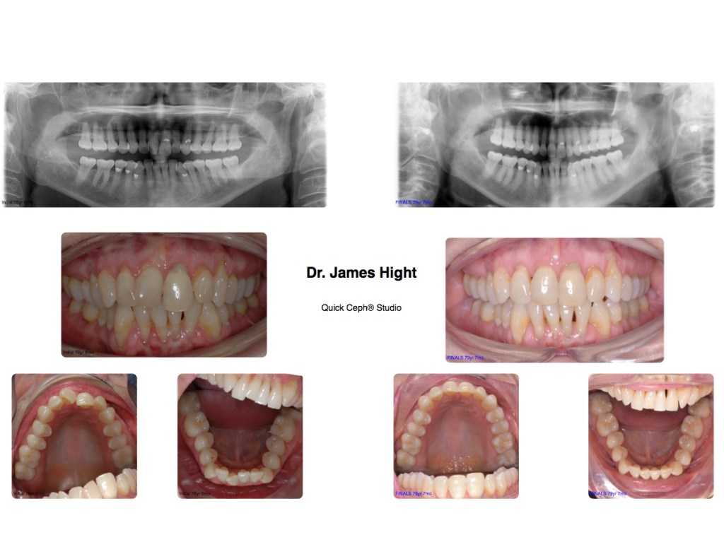 Comparison38a-impaction