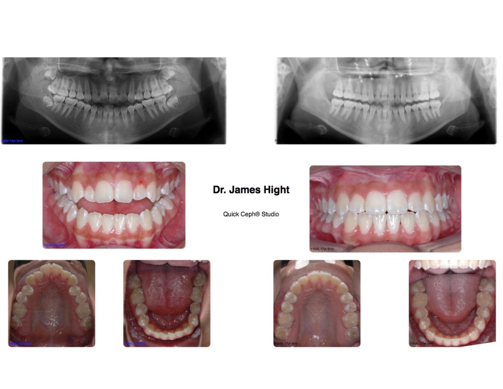 Comparison39-impaction