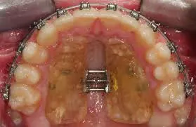 palatal expansion device inside of a mouth