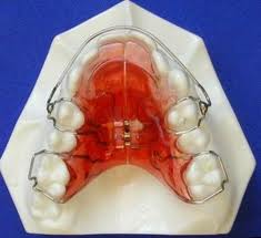 palatal expansion device