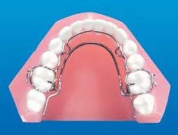 illustration of mouth with Crozat appliance