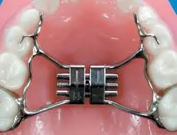 palatal expansion device